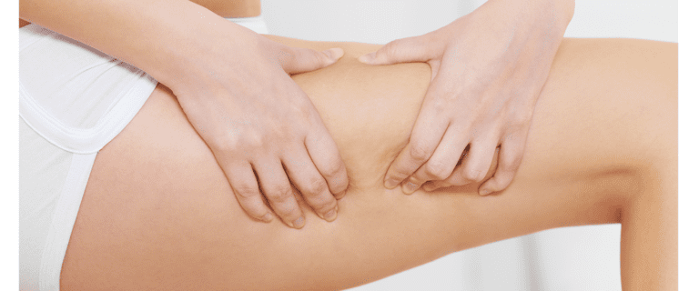 What is cellulite? How is cellulite treated?